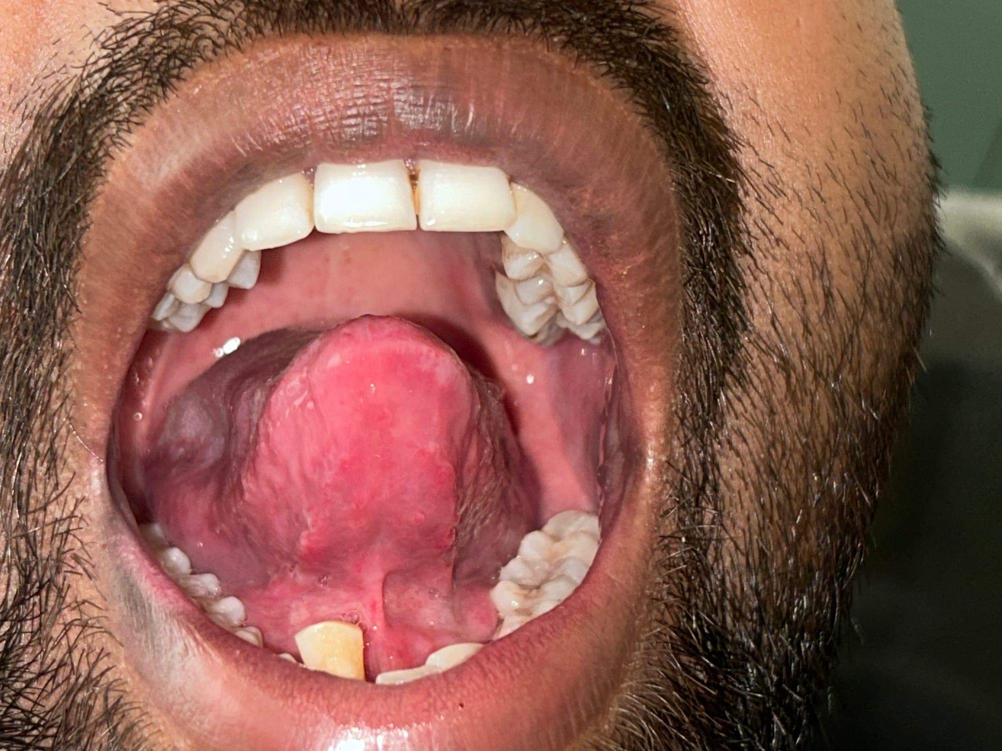 Traumatic ulcer after