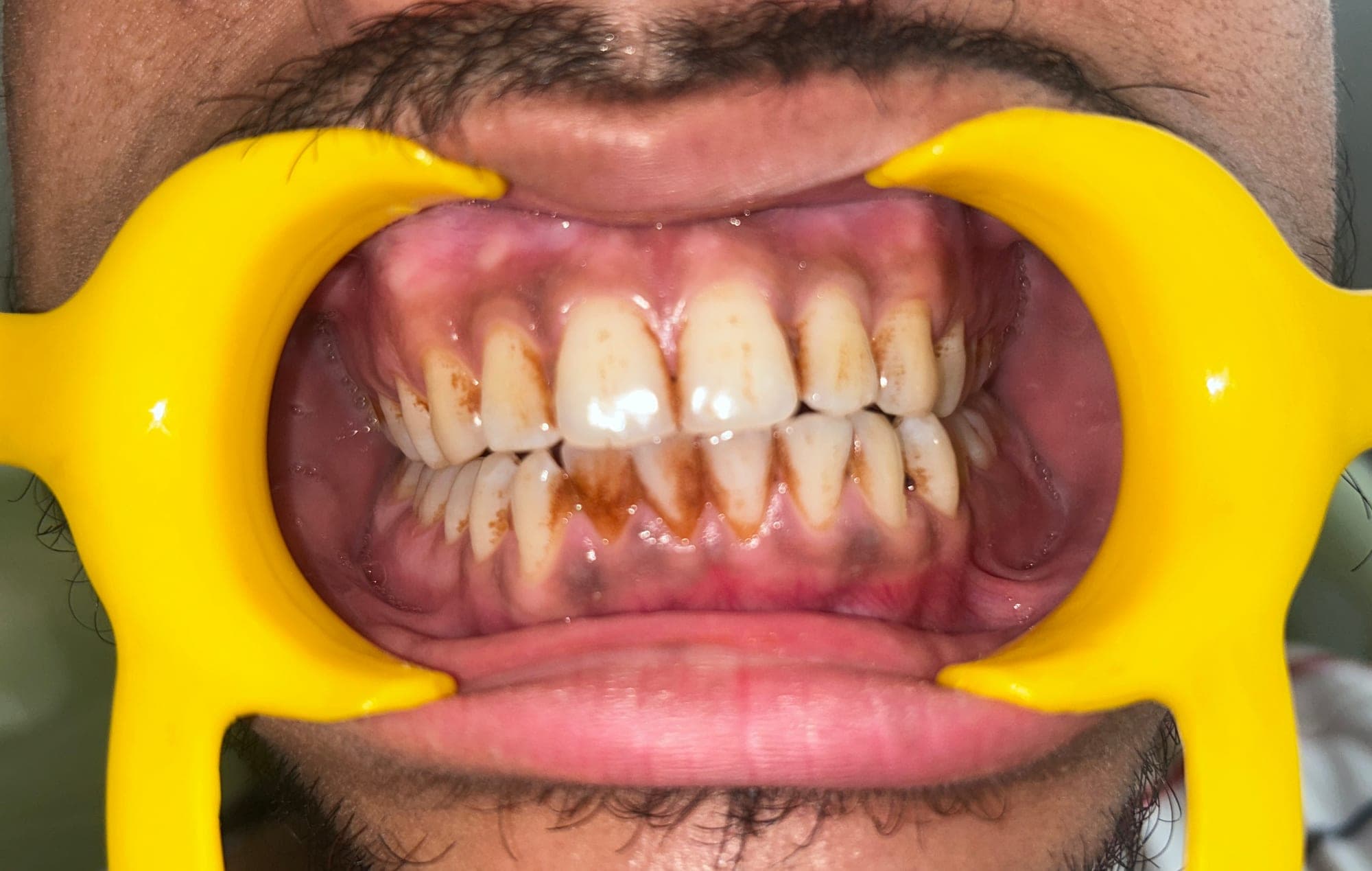 U/S scaling done before